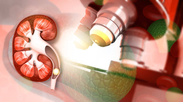Мочекаменная болезнь (камни в почках): консервативные и хирургические методы лечения, профилактика