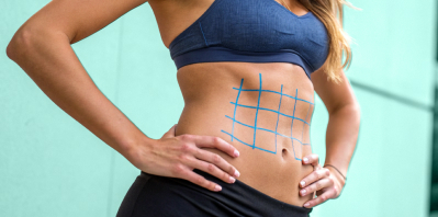 Грыжа и диастаз: когда нужна комплексная хирургия