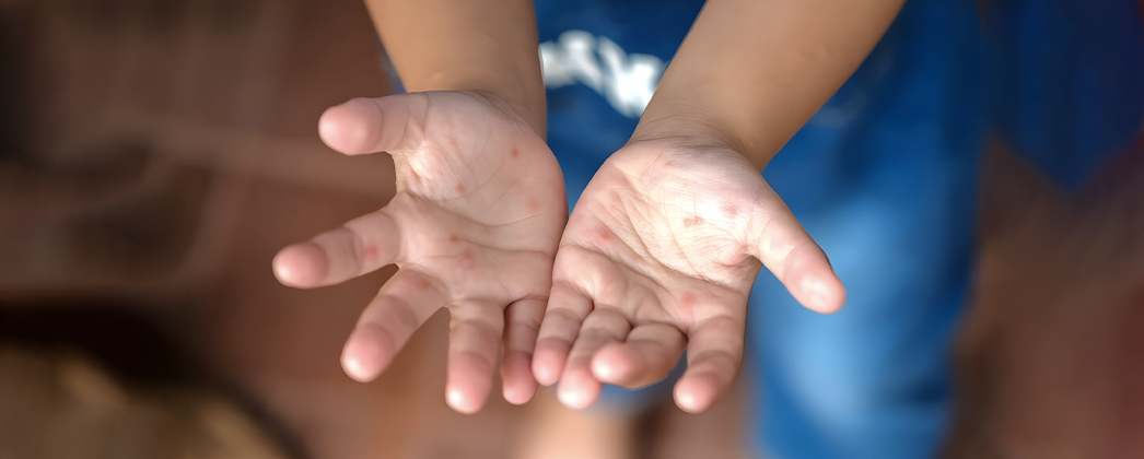 В Ростове начался эпидсезон энтеровирусных инфекций, включая вирус Коксаки