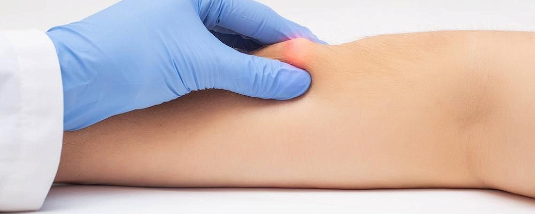 Липомы и атеромы: что делать с шишками под кожей летом?