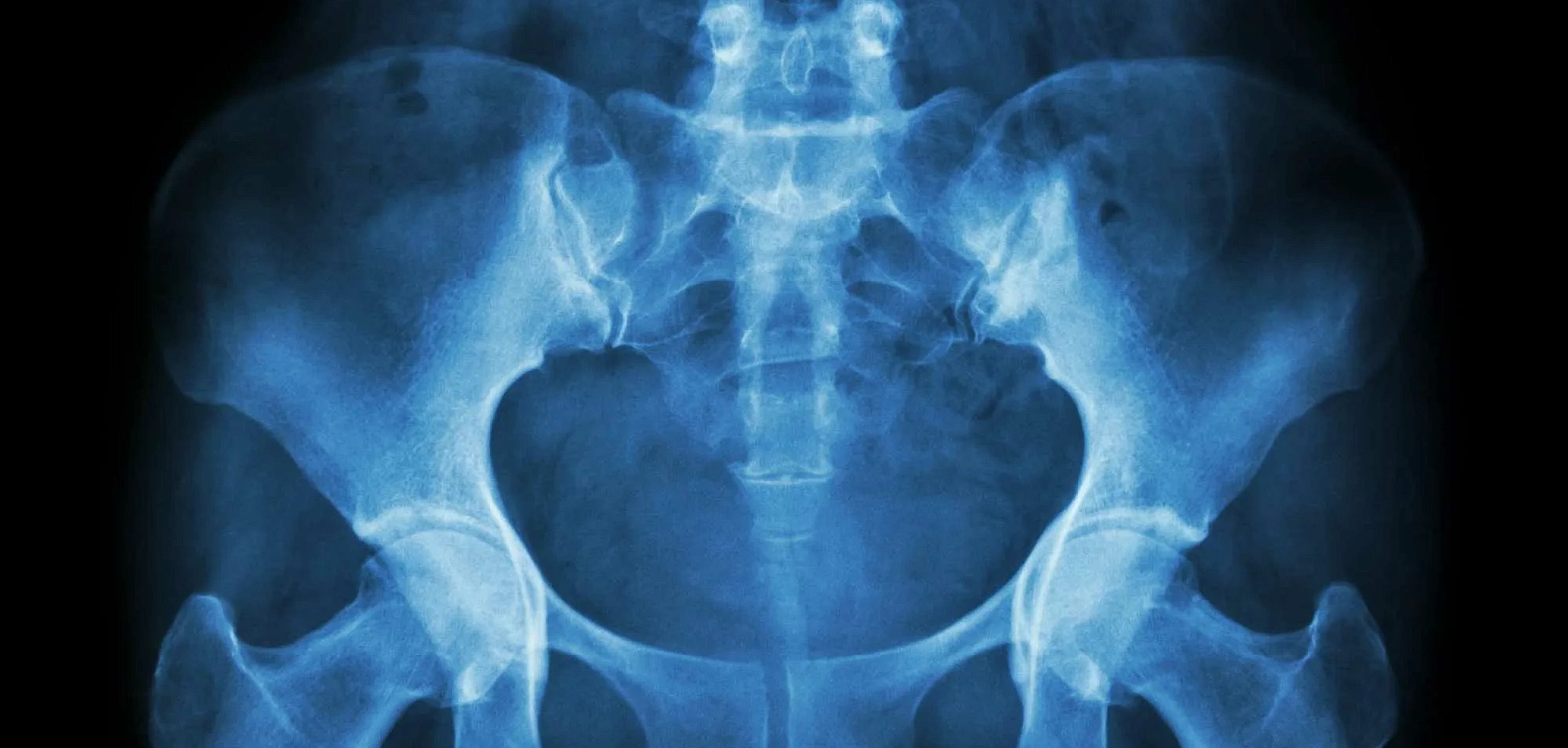 Рентген костей таза