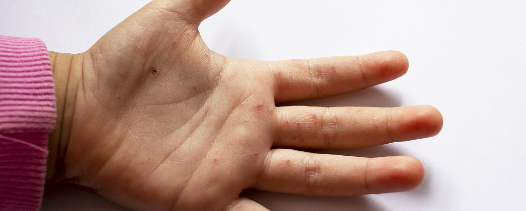 Как лечить вирус Коксаки у ребенка безопасно? Рекомендации врачей клиники Евродон.