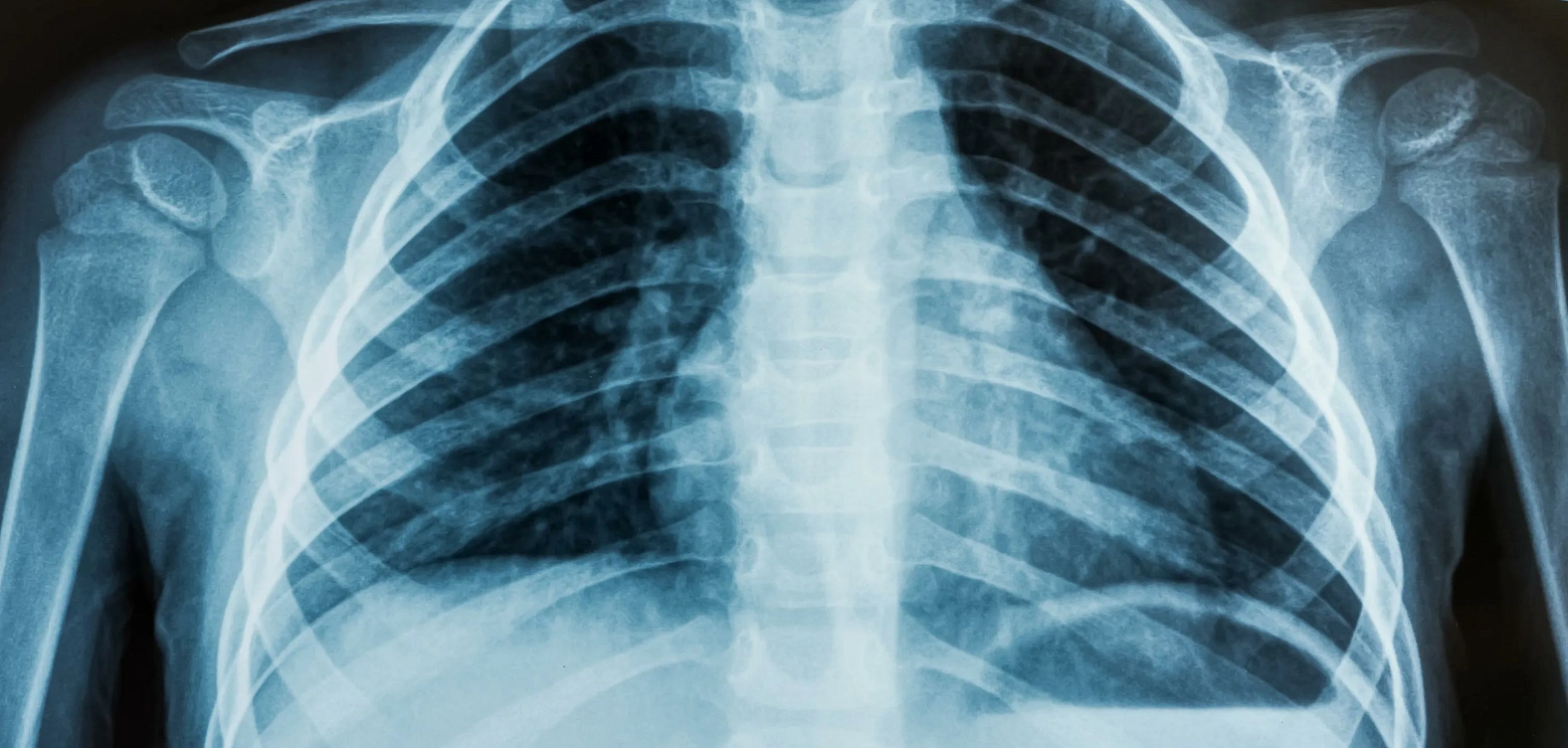 Рентен органов грудной клетки