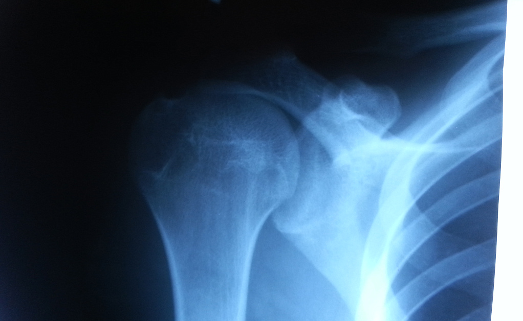 Rentgen verhnih plechevih sustavov v Evrodone