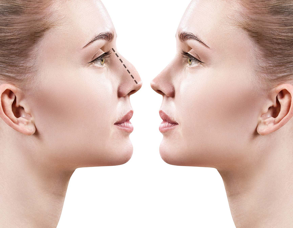 Rinoplastika v klinike Evrodon